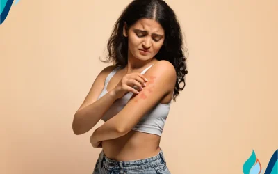 Is Hard Water Irritating Your Eczema?