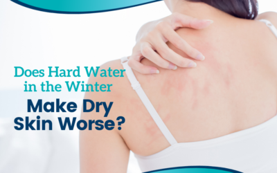 Does Hard Water in the Winter Make Dry Skin Worse?