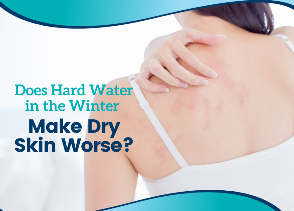 Does Hard Water in the Winter Make Dry Skin Worse?